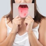 Oral Alerji Sendromu (OAS) Nedir?