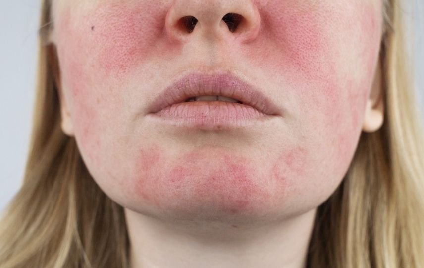Roza (Gül) Hastalığı Alerjik Midir?